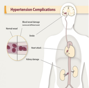 What is hypertension? Image